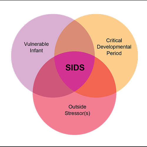The Triple-Risk Model for understanding SIDS deaths is depicted as three intersecting circles. Each circle represents a scenario that, when combined with the other scenarios, may result in SIDS. The circles are labeled Vulnerable Infant, Critical Developmental Period, and Outside Stressor(s). The space where the three circles overlap is labeled SIDS.