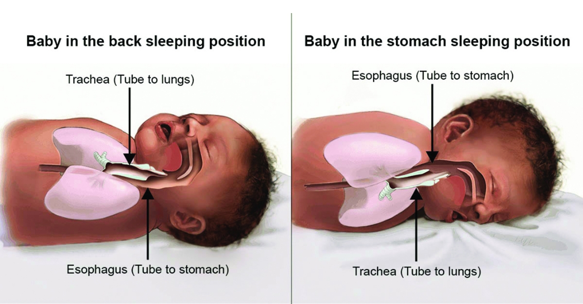 Illustrations showing the back and stomach sleeping positions and the placement of the infant’s trachea (tube to lungs) and esophagus (tube to stomach). Figure 1 shows the back sleep position, in which the trachea lies on top of the esophagus. Figure 2 shows the stomach sleep position, in which the esophagus in on top of the trachea.