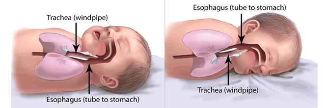 Illustrations showing the back and stomach sleeping positions and the placement of the infant's trachea (tube to lungs) and esophagus (tube to stomach). Figure 1 shows the back sleep position in which the trachea lies on top of the esophagus. Figure 2 shows the stomach sleep position in which the esophagus in on top of the trachea.