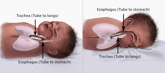Illustrations showing the back and stomach sleeping positions and the placement of the infant's trachea and esophagus. Figure 1 shows the back sleep position in which the trachea lies on top of the esophagus. Figure 2 shows the stomach sleep position in which the esophagus in on top of the trachea.